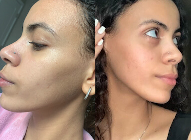 Lara O. before and after