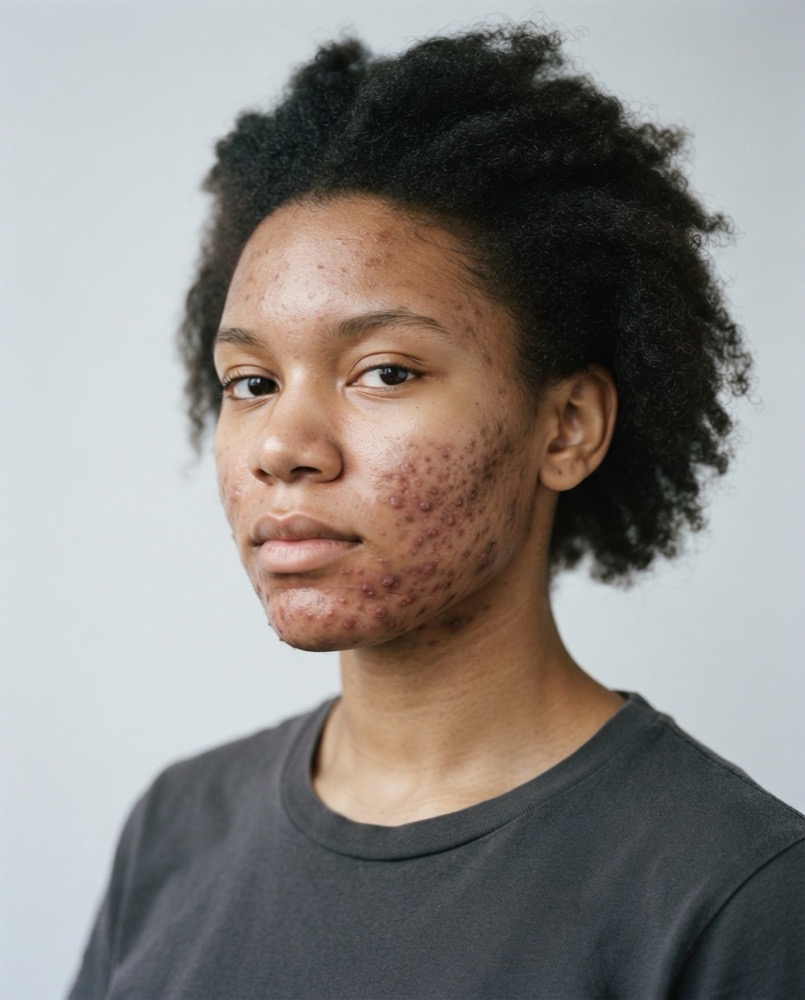 cystic acne