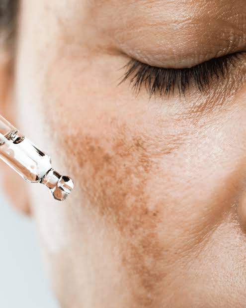 melasma