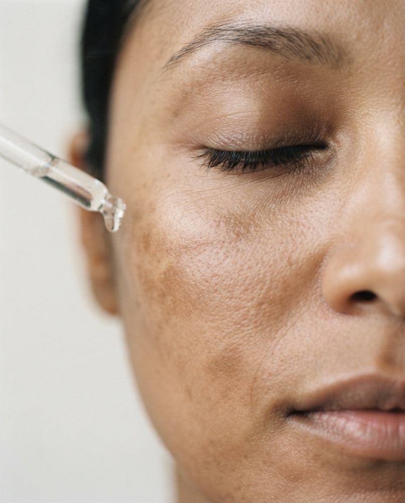 melasma