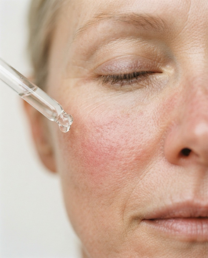 rosacea