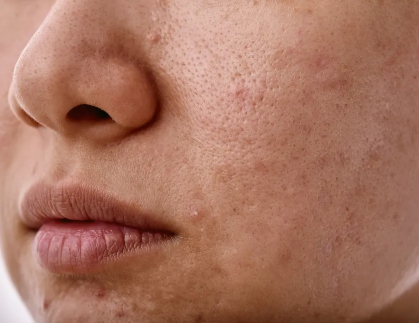 Dull skin