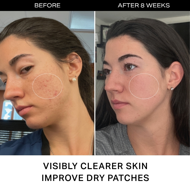 Pregnancy Skin