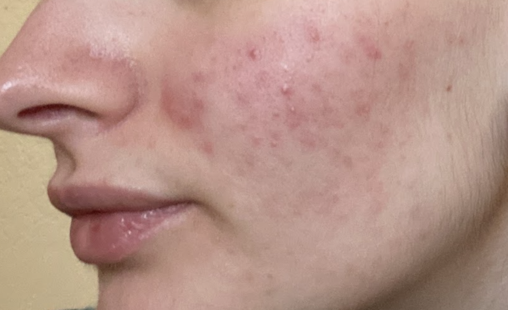 Hormonal breakouts