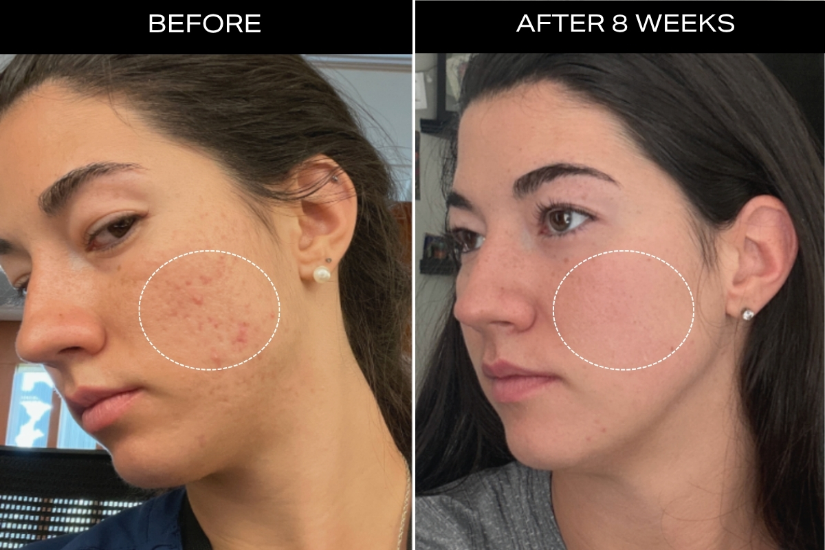 Visibly Clearer & Healthier Skin