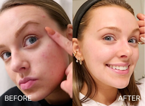 Before and after results for pigmentation and dark spots
