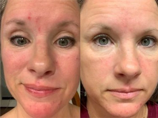 Shannon F. before and after